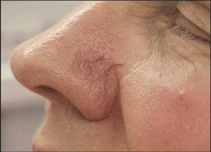 Thread vein removal treatment at Clinic Visjeune